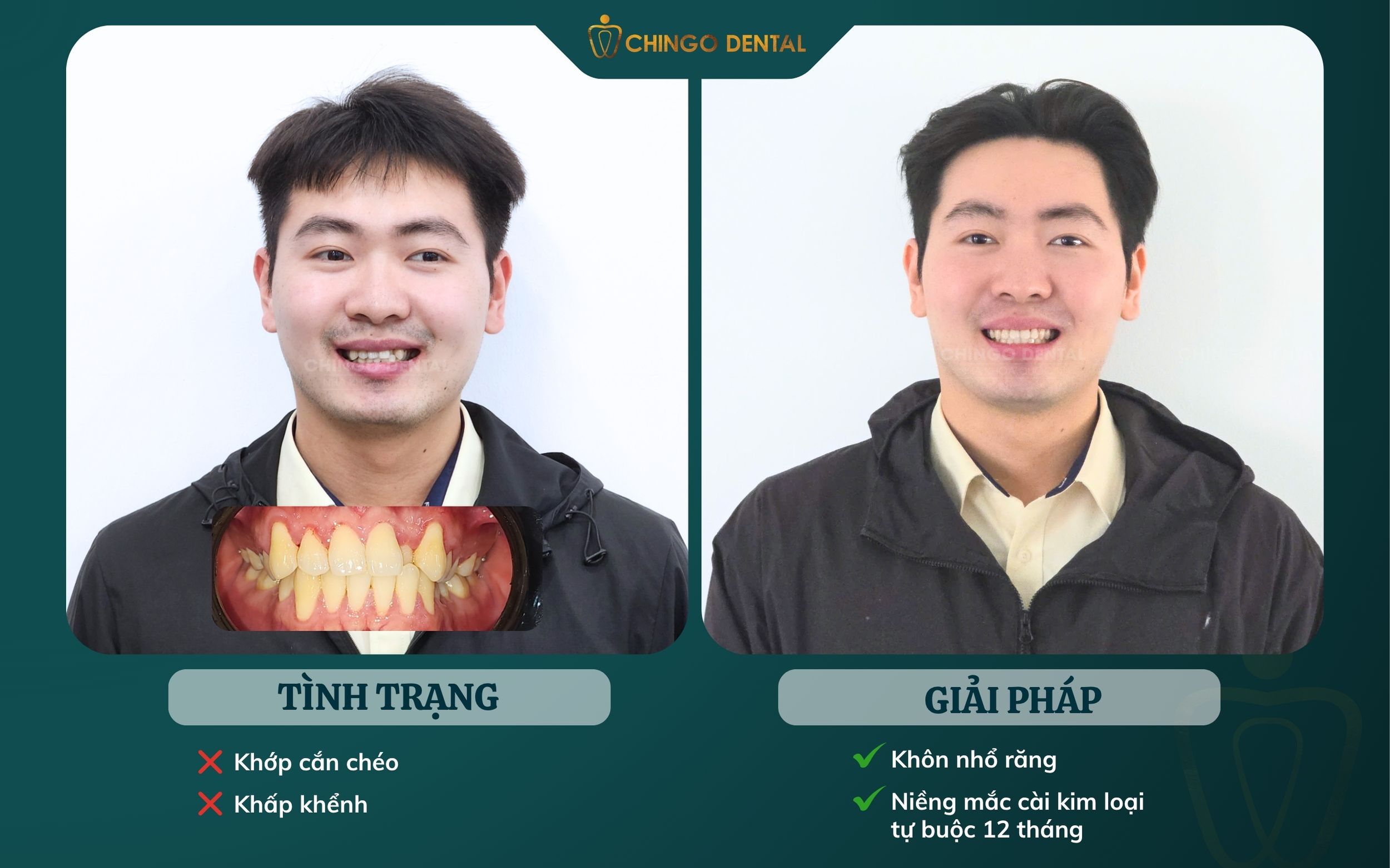 khách niềng chingo