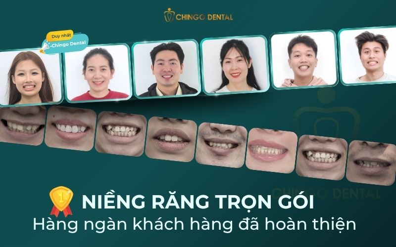 giá niềng răng hà nội