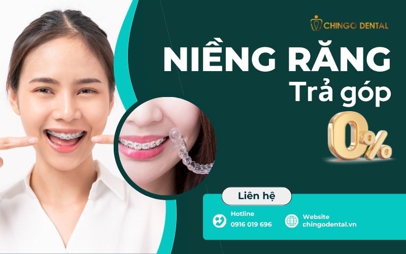 niềng răng trả góp