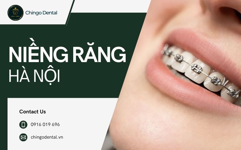 niềng răng hà nội