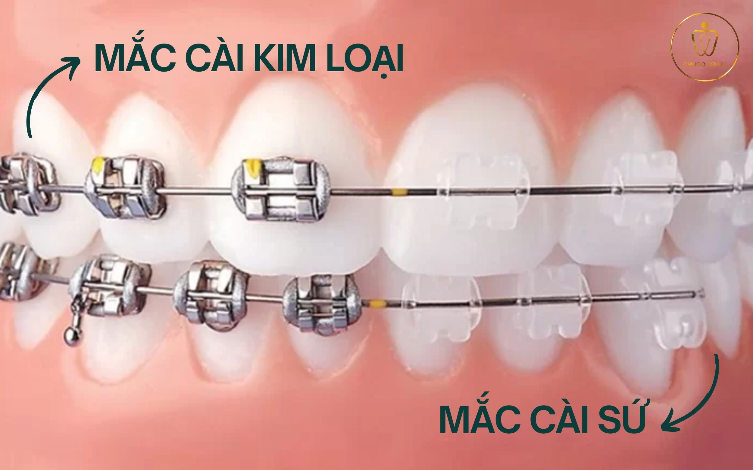 chi phí niềng răng tại hà nội