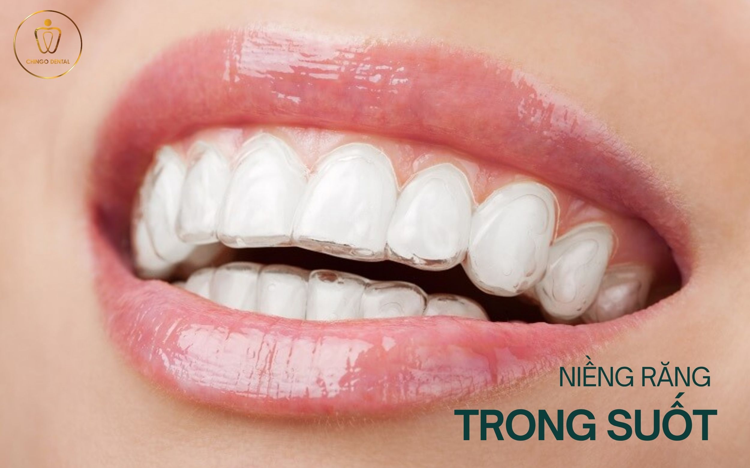 Niềng răng trong suốt hà nội