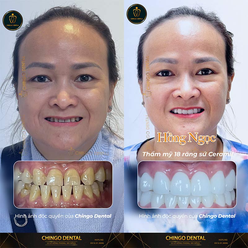 giá bọc răng sứ tại đà nẵng