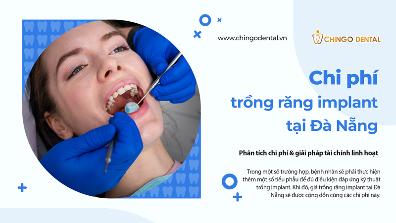 giá trồng răng implant tại đà nẵng