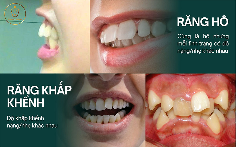 Giá Niềng Răng Hà Nội Bao Nhiêu - Gợi Ý Địa Chỉ Trả Góp "Chi Phí Mềm" Nhất Thủ Đô 2 niềng răng ở Hà Nội giá bao nhiêu