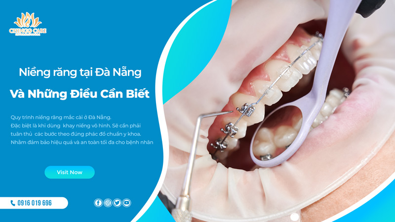 niềng răng trong suốt Đà Nẵng
