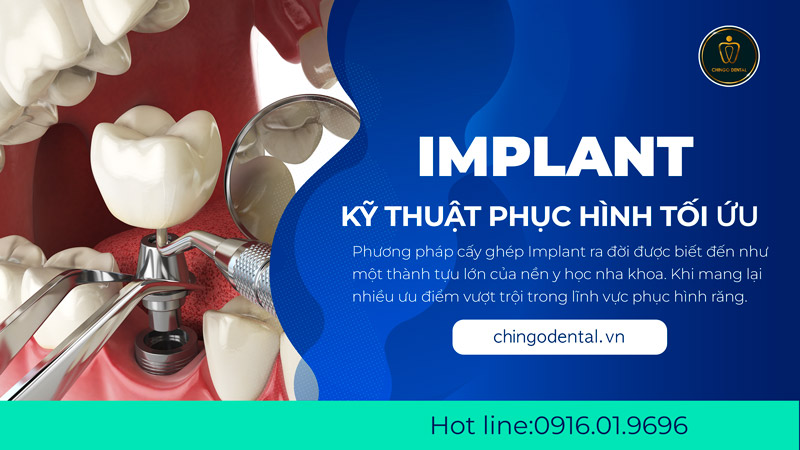 giá trồng răng implant tại đà nẵng