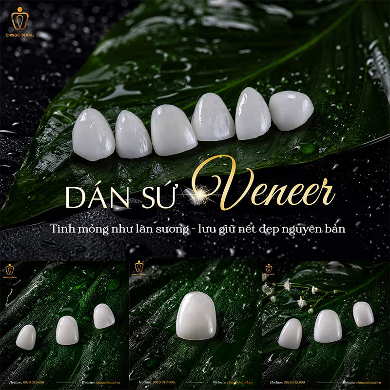 bảng giá dán răng sứ Đà Nẵng