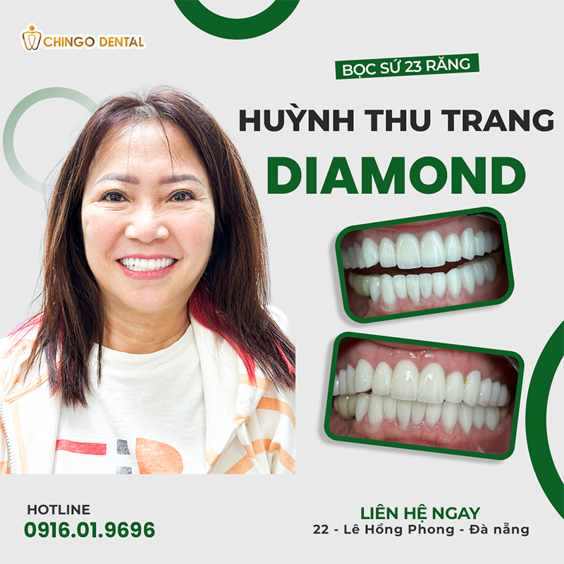 bảng giá làm răng sứ hà nội