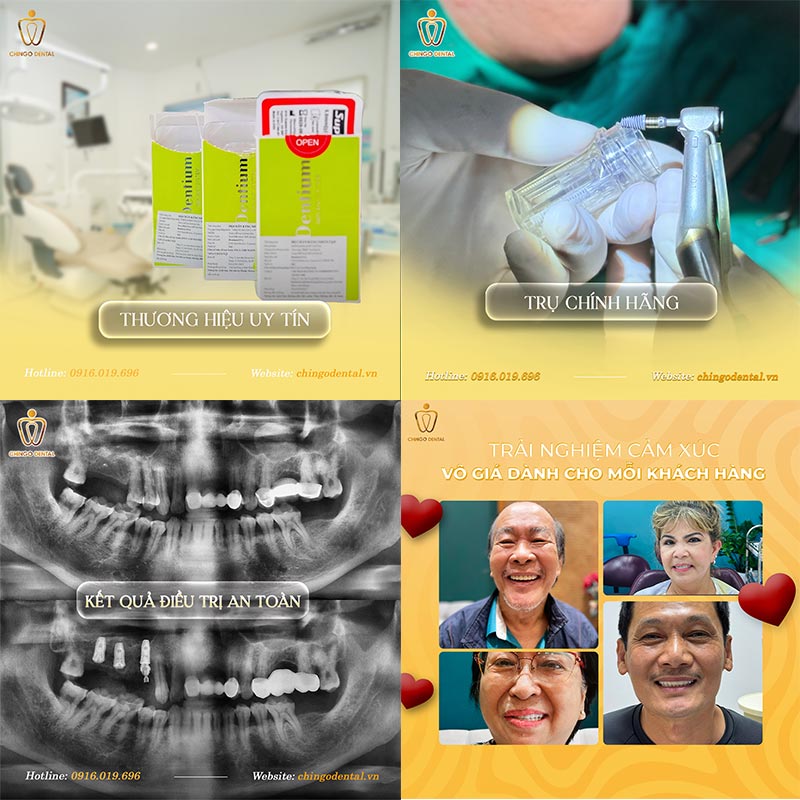 Trồng răng Implant Đà Nẵng 2 bảng giá trồng răng implant tại Đà Nẵng
