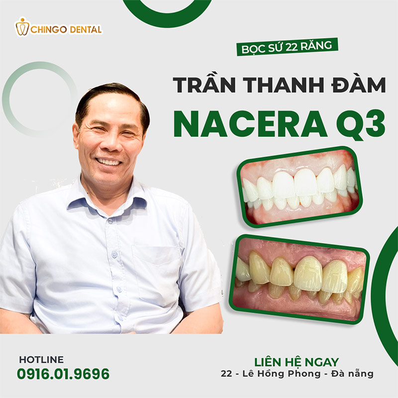 bọc răng sứ ở đâu tốt nhất hà nội
