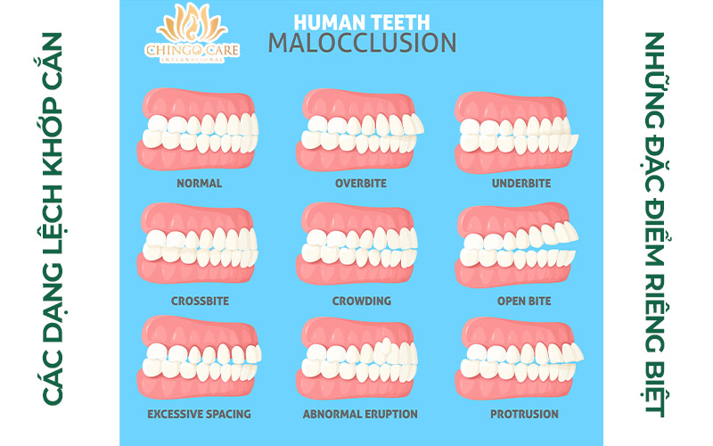 Các dạng răng lệch khớp cắn