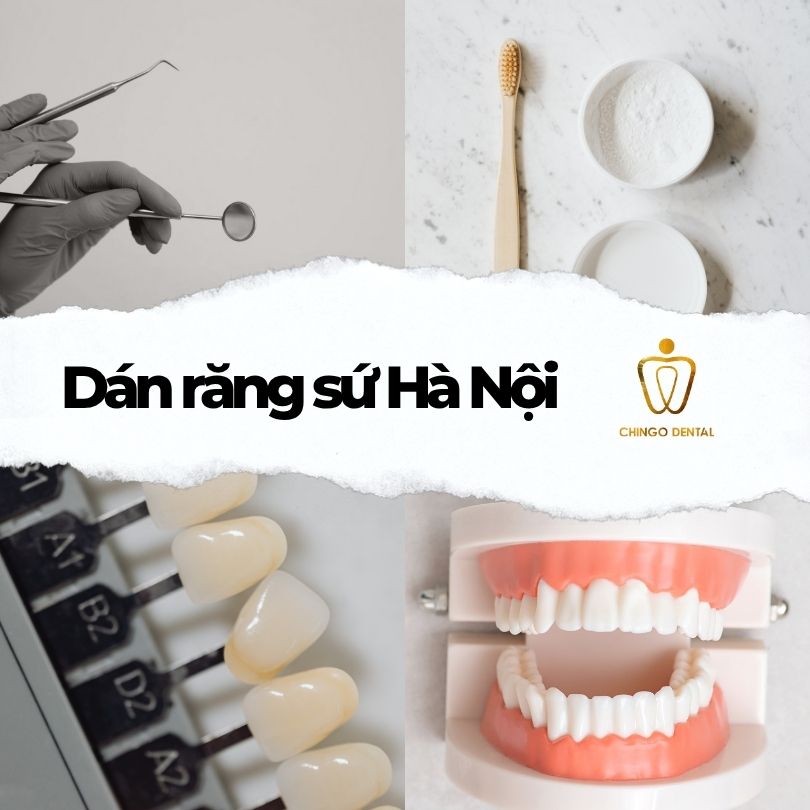 dán răng sứ Hà Nội