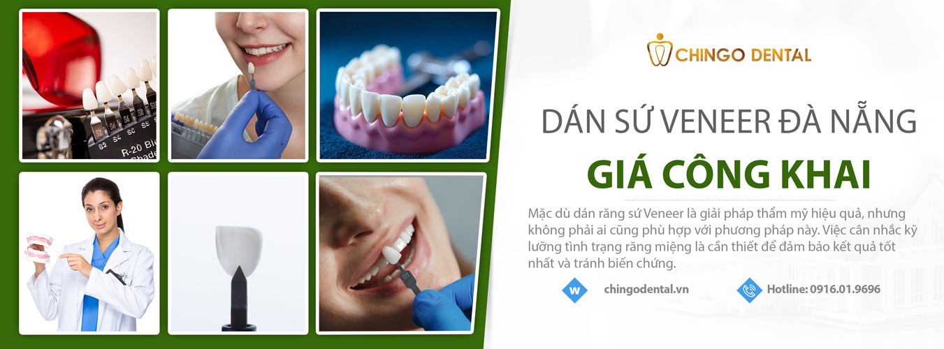 Dán răng sứ Đà Nẵng 4 dán răng sứ veneer Đà Nẵng