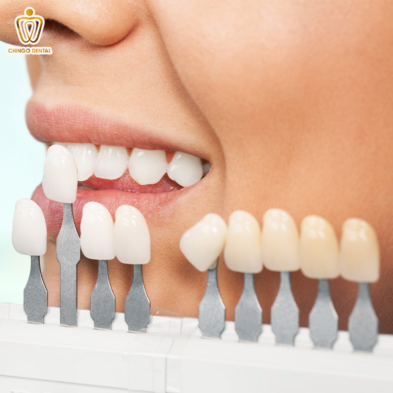 dán sứ veneer ở hà nội