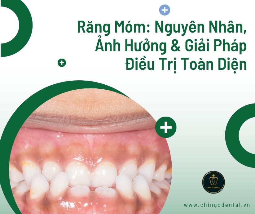 Điều trị răng móm