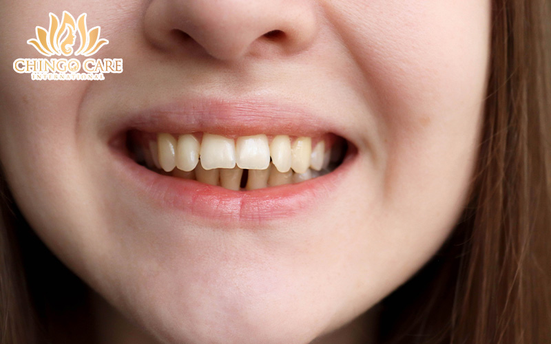 điều trị răng vẩu như thế nào 