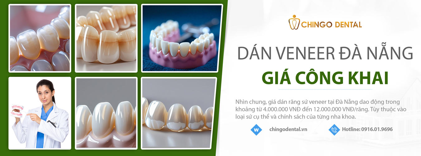 Giá dán răng sứ veneer Đà Nẵng 