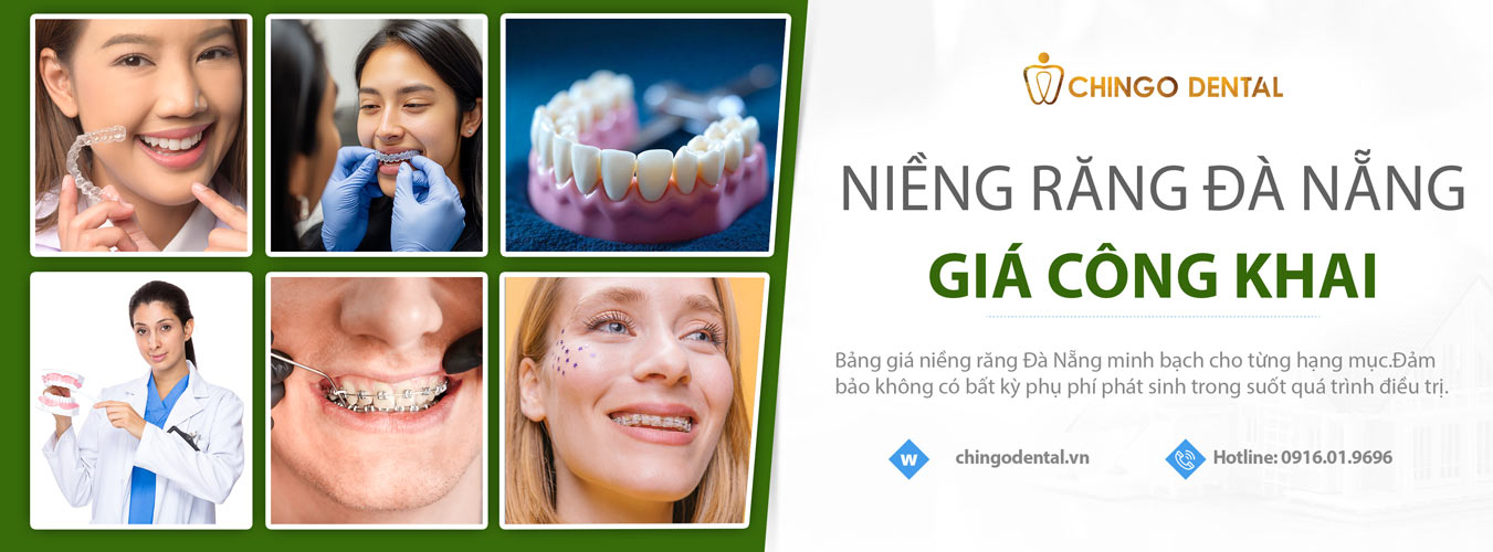 giá niềng răng Đà Nẵng