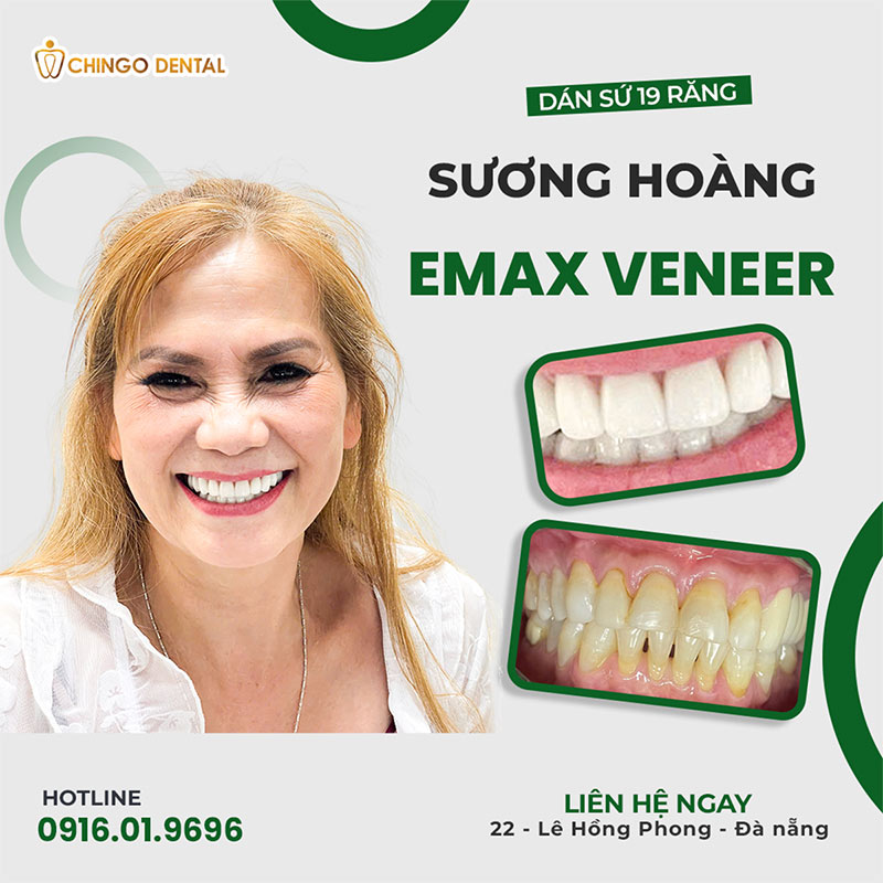 làm răng sứ ở đâu tốt nhất Hà Nội