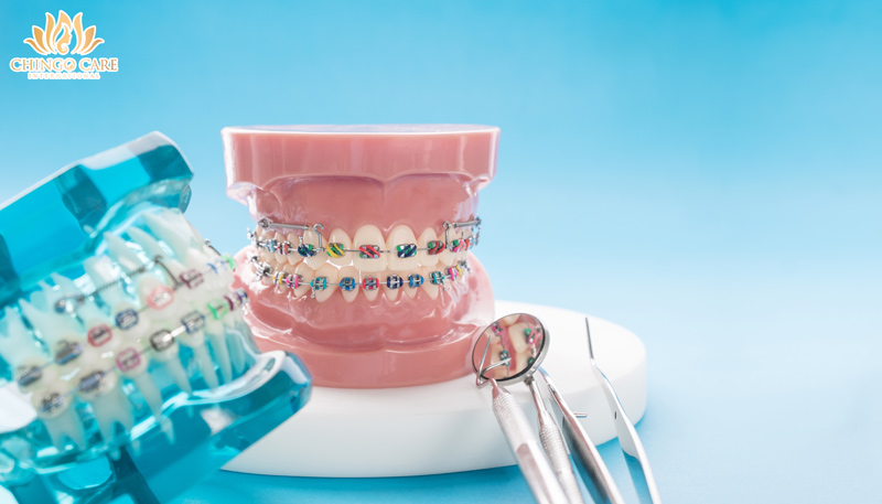 niềng răng mắc cài kim loại là gì