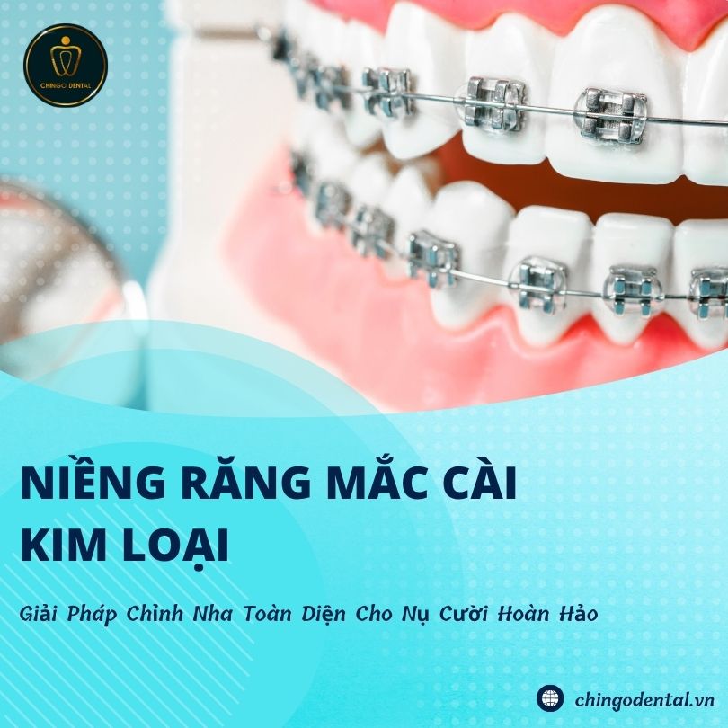niềng răng mắc cài kim loại 
