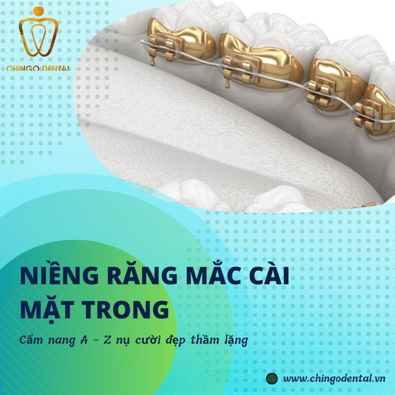niềng răng mắc cài mặt trong