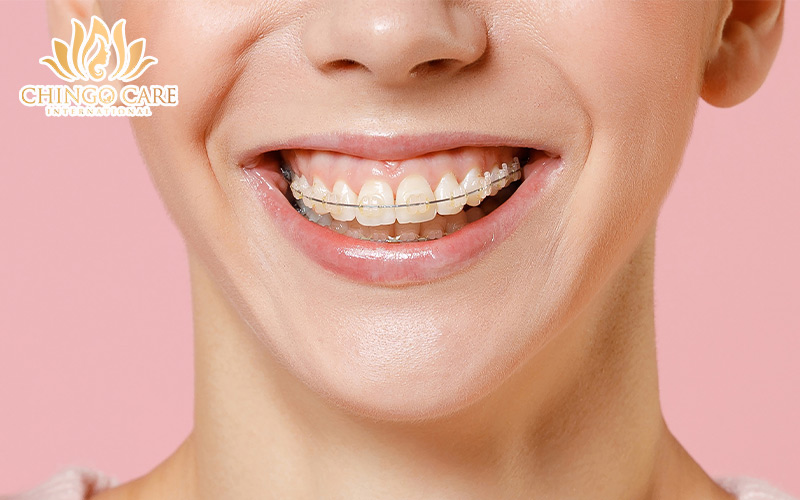 niềng răng mắc cài sứ thường