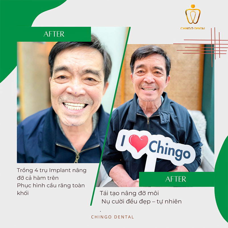 trồng răng implant tại hà nội