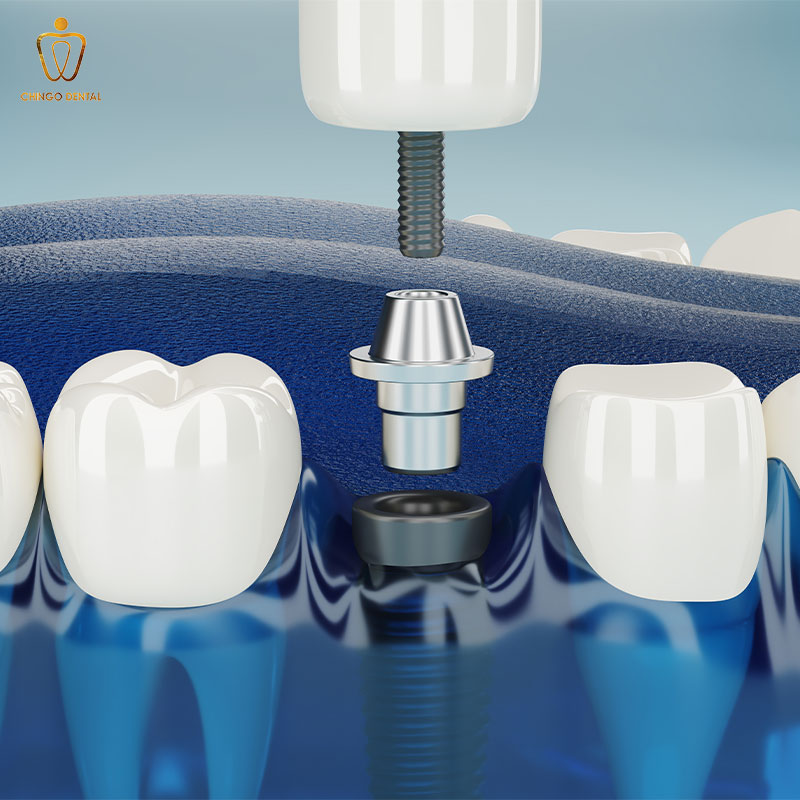 trồng răng implant giá rẻ hà nội