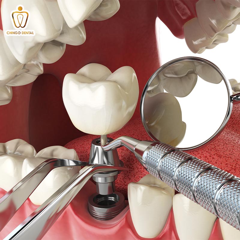 trồng răng implant hà nội