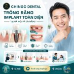 trồng răng implant tốt nhất ở hà nội
