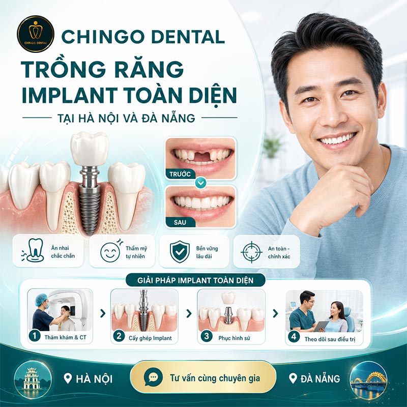 Trồng răng Implant 34 trồng răng implant tốt nhất ở hà nội