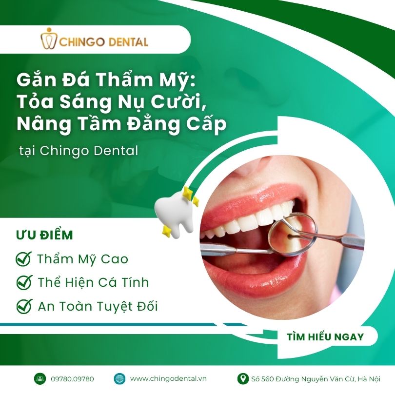 gắn đá thẩm mỹ ở Hà Nội