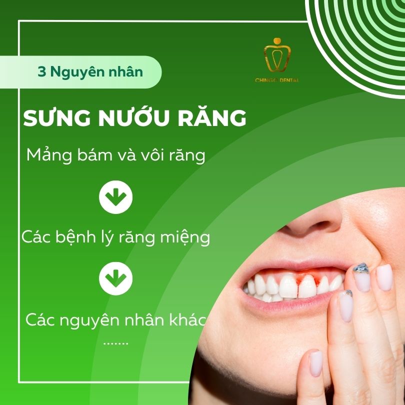 bé bị sưng nướu răng phải làm sao
