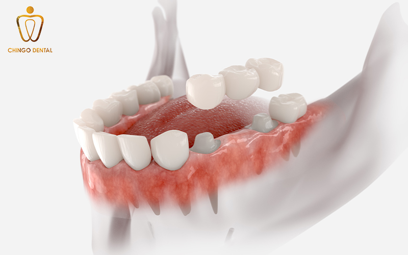 giá trồng răng sứ cố định