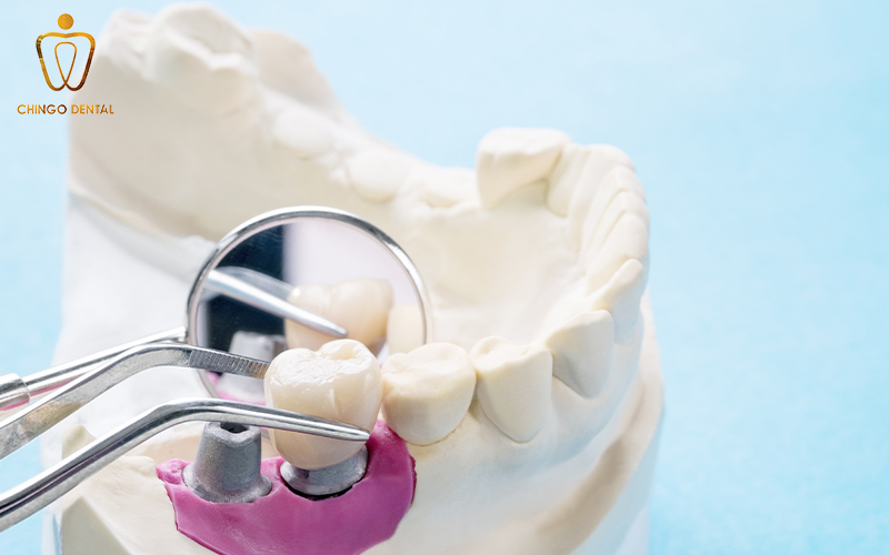 nhược điểm của trồng răng implant 