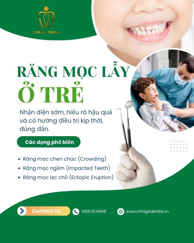 răng mọc lẫy ở trẻ