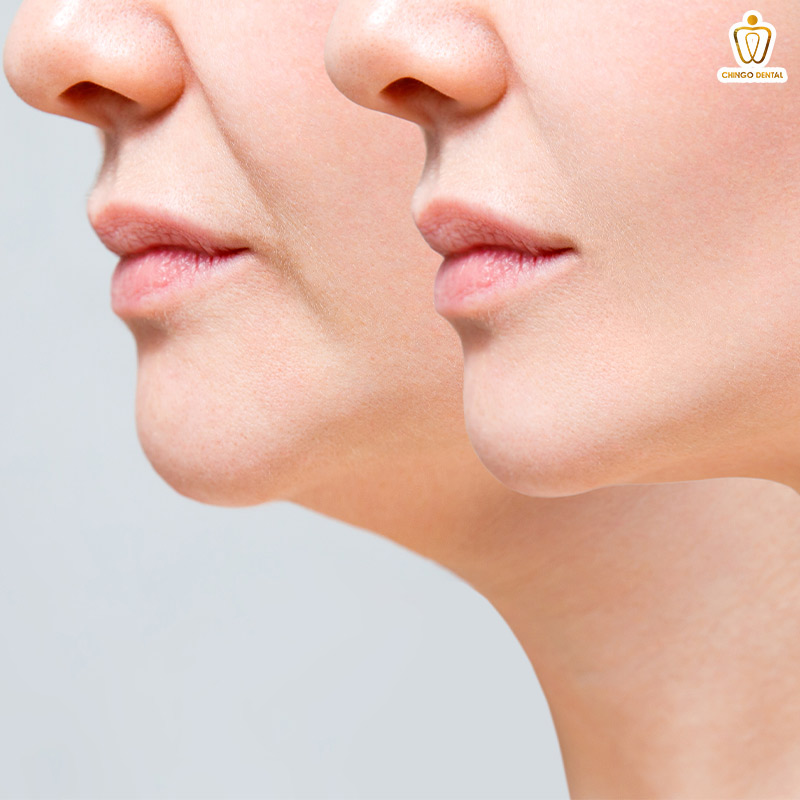 cằm lẹm là như thế nào