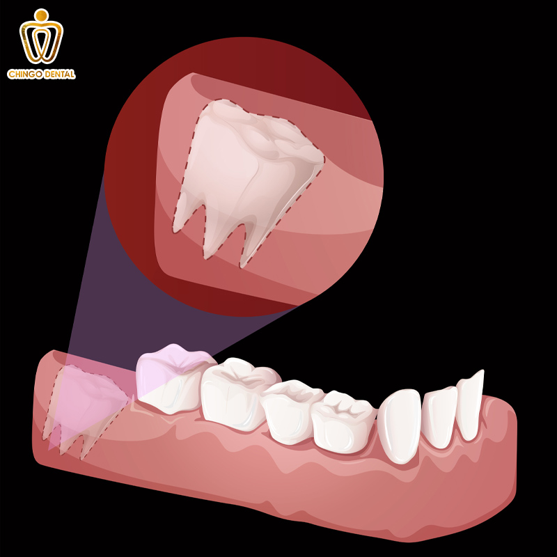 dấu hiệu của mọc răng khôn