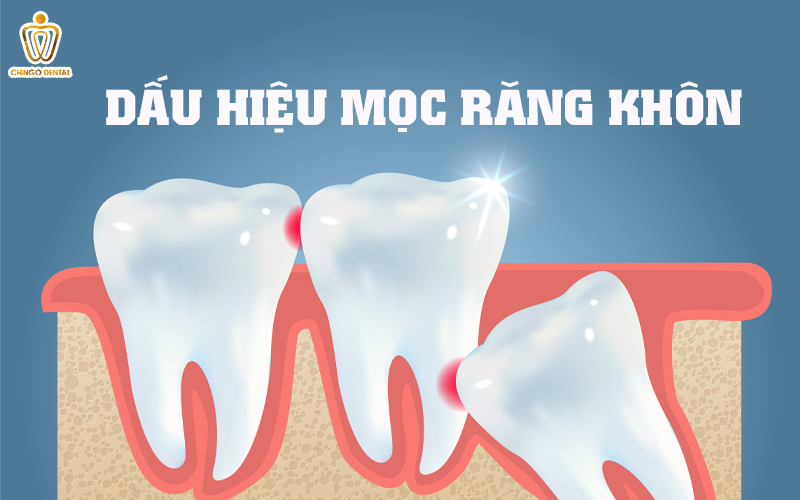 dấu hiệu mọc răng khôn