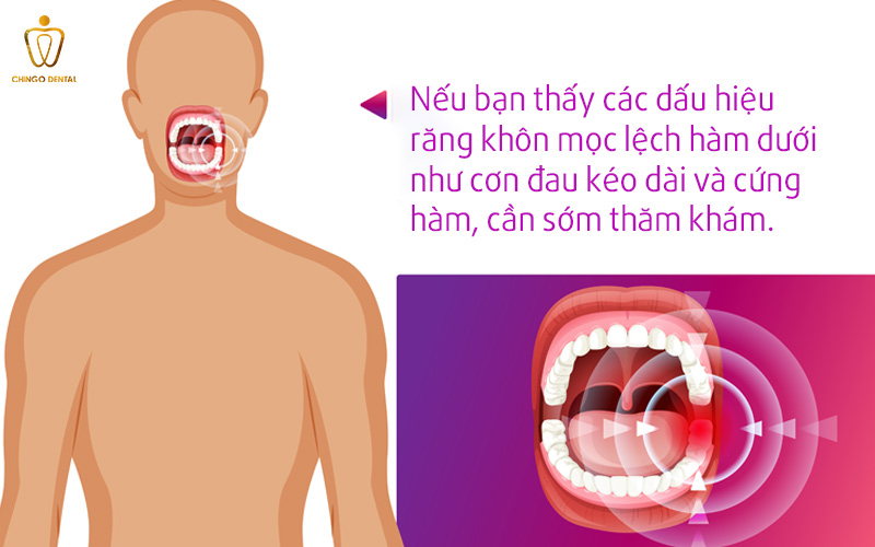 dấu hiệu răng khôn mọc lệch