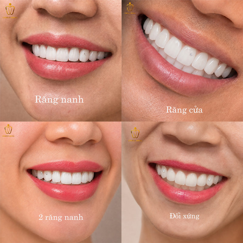 Đính Đá Răng Bao Nhiêu Tiền? Bảng Giá Gắn Đá Thẩm Mỹ Ở Đà Nẵng 5 hình ảnh đính đá răng đẹp Chingo Đà Nẵng