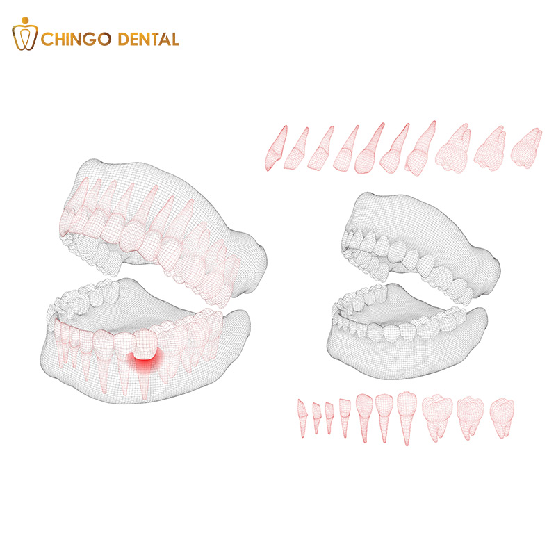 áp xe răng là gì