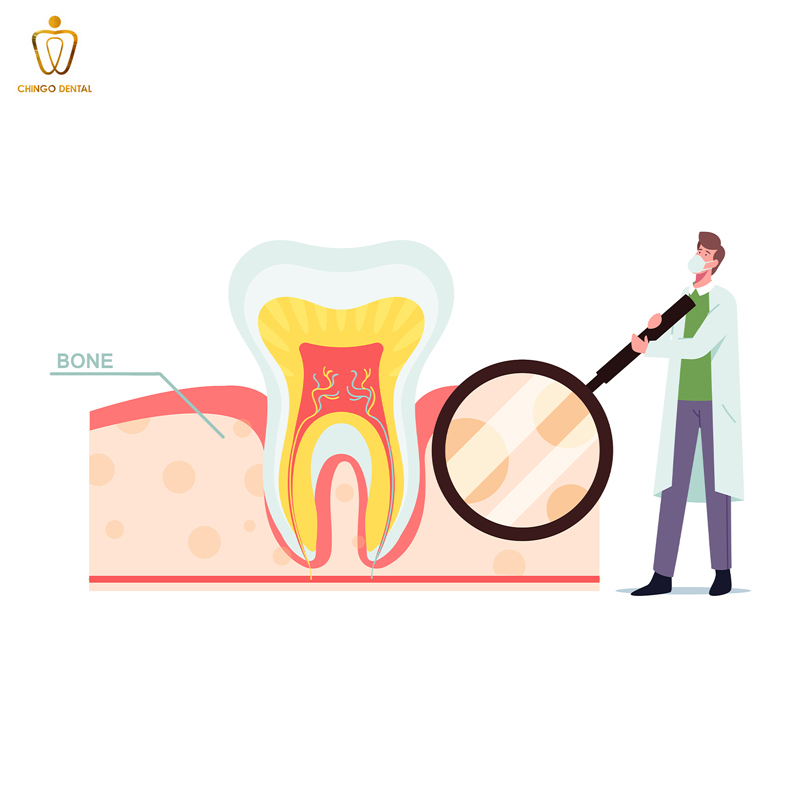 Nang Thân Răng Là Gì? Biến Chứng Tiêu Xương và Nguy Cơ Tái Phát Đáng Lo Ngại 1 nang chân răng là gì