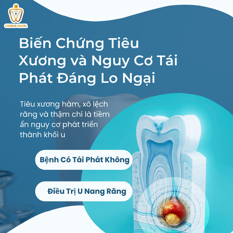 Nang Thân Răng Là Gì? Biến Chứng Tiêu Xương và Nguy Cơ Tái Phát Đáng Lo Ngại 4 nâng khớp răng là gì