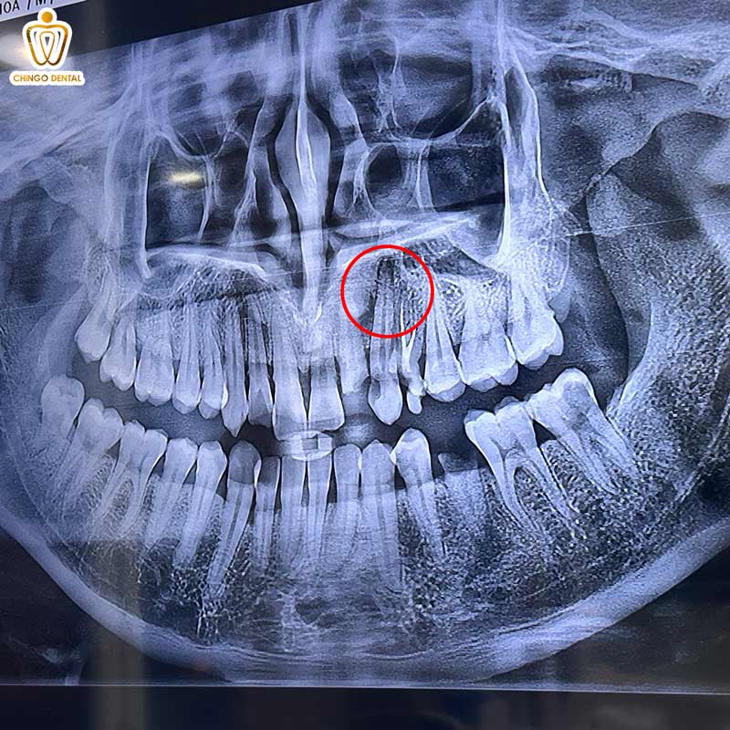 Nang Thân Răng Là Gì? Biến Chứng Tiêu Xương và Nguy Cơ Tái Phát Đáng Lo Ngại 3 nang răng là gì