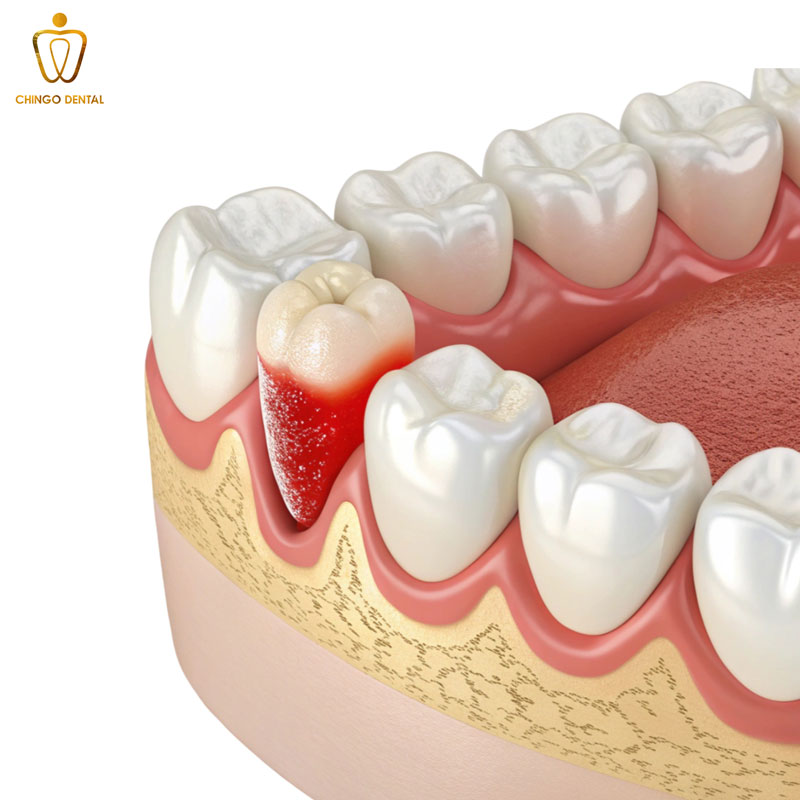 những biến chứng sau khi nhổ răng số 8