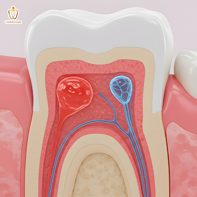 phác đồ điều trị viêm quanh chóp răng