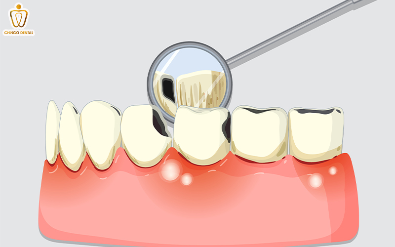 Trám Răng Sâu: Giải Pháp Phục Hồi Răng Thật Toàn Diện 2 trám răng là gì